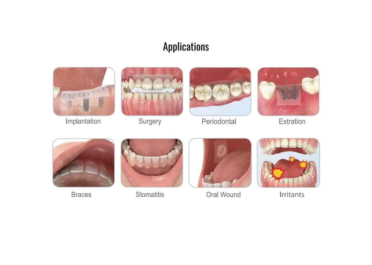 8 different types of applications. From left-to-right, top-to-bottom - implantation, surgery, periodontal, extraction, braces, stomatitis, oral wound, and irritants.