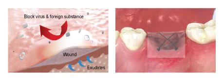 Ora-Aid membrane protective barrier layer and adhesive layer.