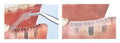 Implantation wound with Ora-Aid being applied after procedure.