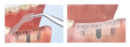 Implantation wound with Ora-Aid being applied after procedure.